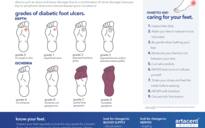 Diabetic Foot Ulcers – What You Need To Know