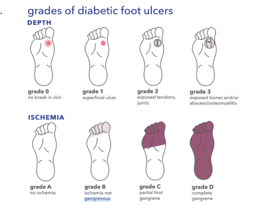Foot Ulcer Classifications