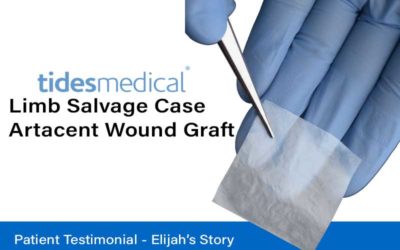 Limb Salvage Case – Artacent Wound Graft