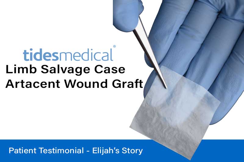 Limb Salvage Case – Artacent Wound Graft