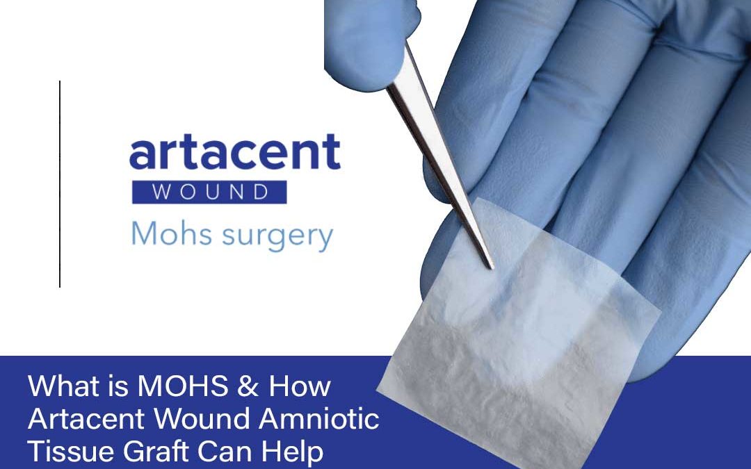 What is MOHS & How Artacent AC Amniotic Tissue Graft Can Help