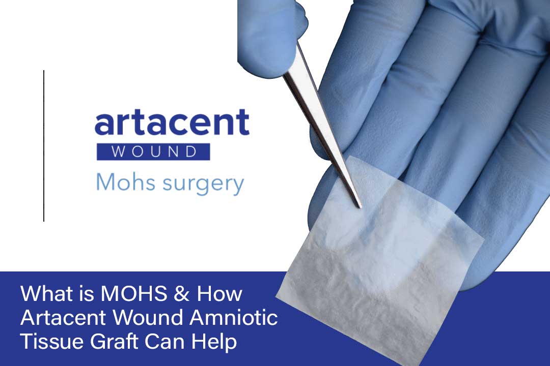 What is MOHS & How Artacent AC Amniotic Tissue Graft Can Help