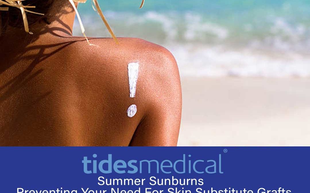 Summer Sunburns – Preventing Your Need For Skin Substitute Grafts