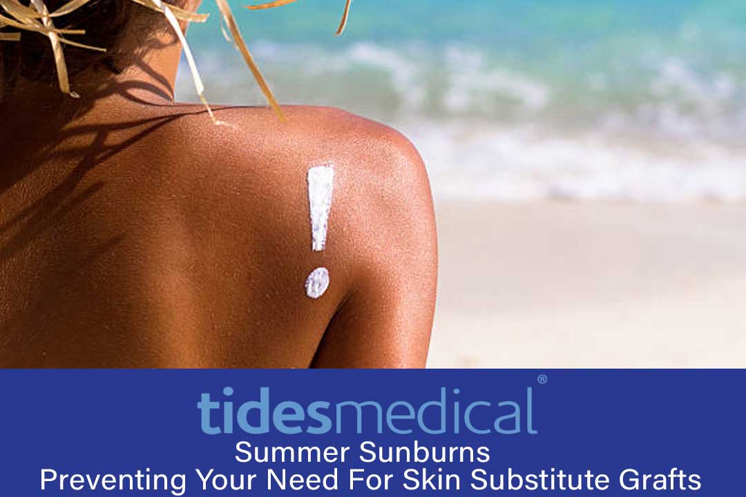 Summer Sunburns – Preventing Your Need For Skin Substitute Grafts
