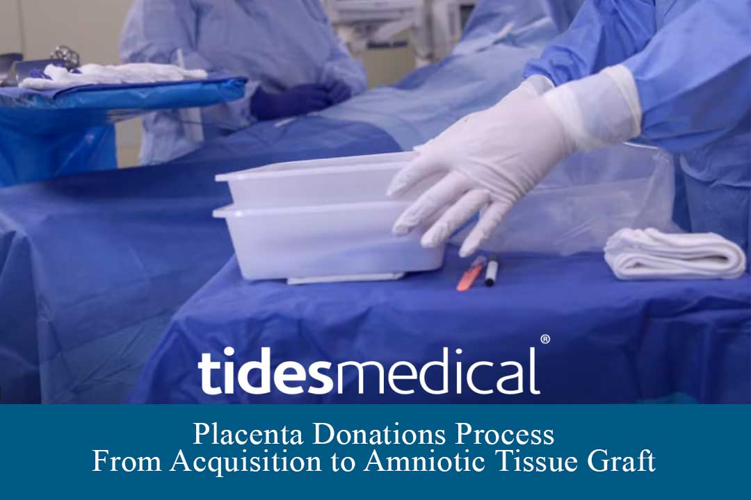 Placenta Donations Process – From Acquisition to Amniotic Tissue Graft